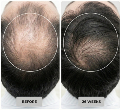 Luma Red Light Therapy Cap - Professional Hair Growth & Scalp Treatment